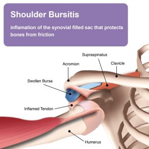 Shoulder Bursitis