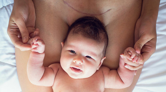 Typische Beschwerden: Kaiserschnitt-Narbe